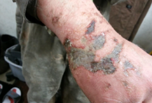 he dangers of caustic soda are well known. This photo illustrates a typical skin injury caused by caustic soda solution on the rig site. 